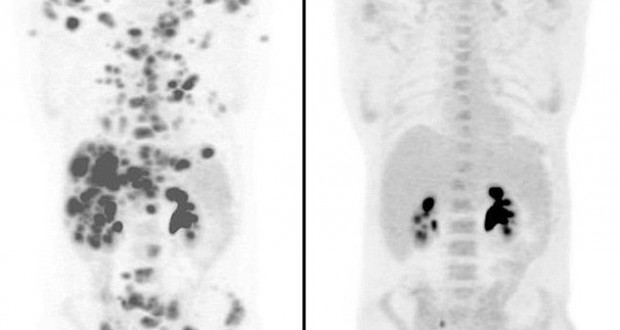 Ezek után hinni fogsz a csodákban – fotó arról, hogyan tűnt el 3 hónap alatt 70 tumor egy férfi testéből