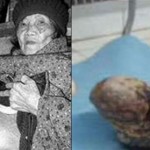 A 92 éves asszony már 60 éve terhes volt!